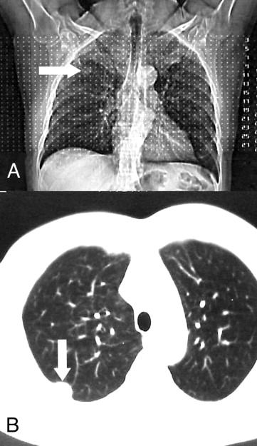 Chest Wall Tumors | The Patient Guide to Heart, Lung, and Esophageal